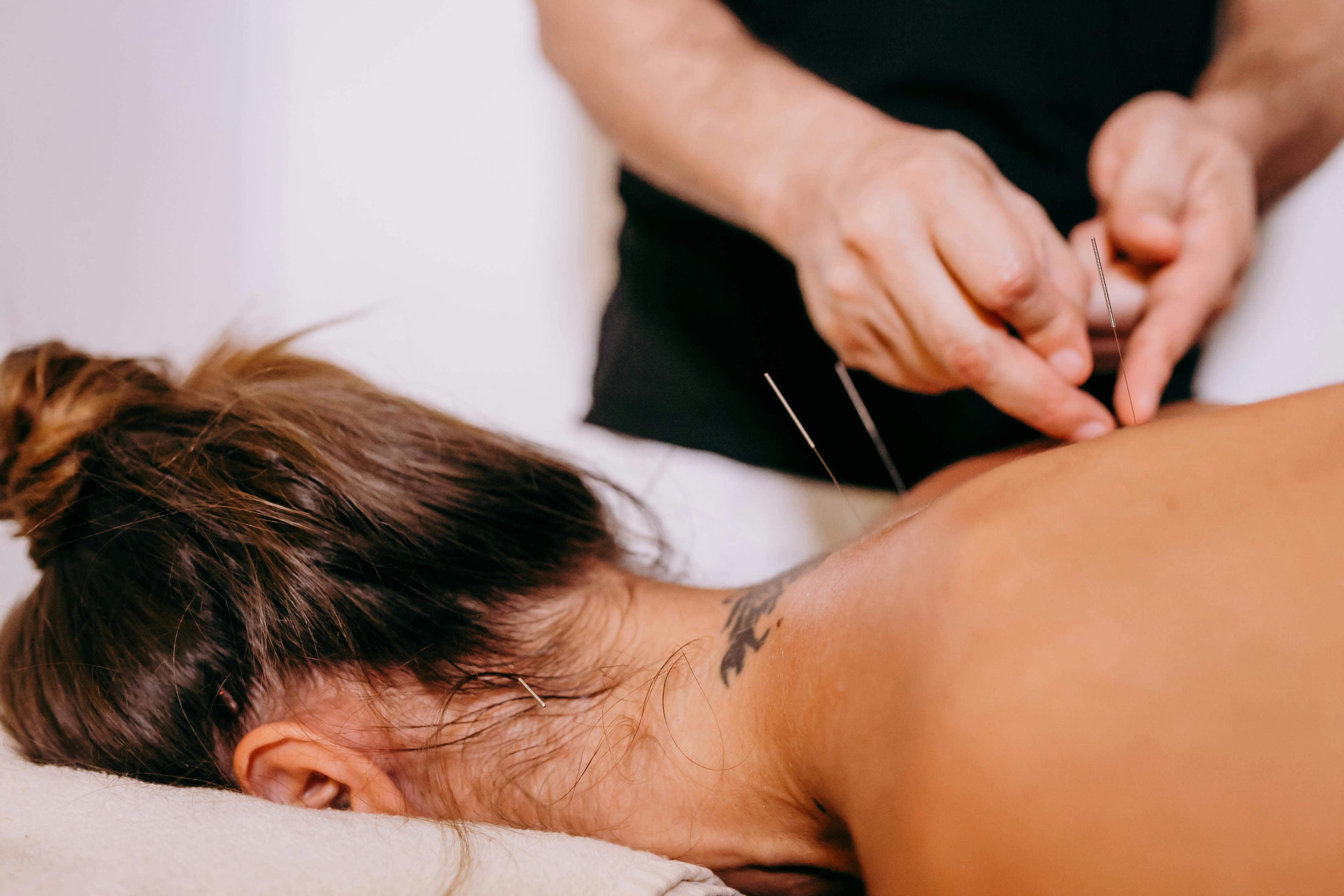 Dry needling treatment being performed